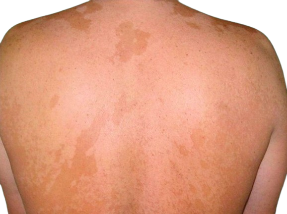 Skin infections (bacterial/viral)